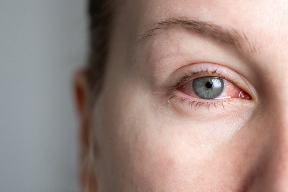 Cocaine Eyes: Recognizing the Physical Signs of Cocaine Use