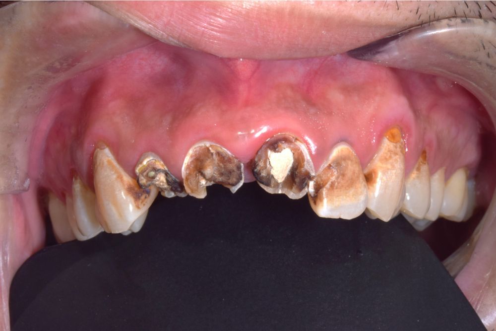Meth Mouth Explained: How Methamphetamine Damages Teeth and Gums